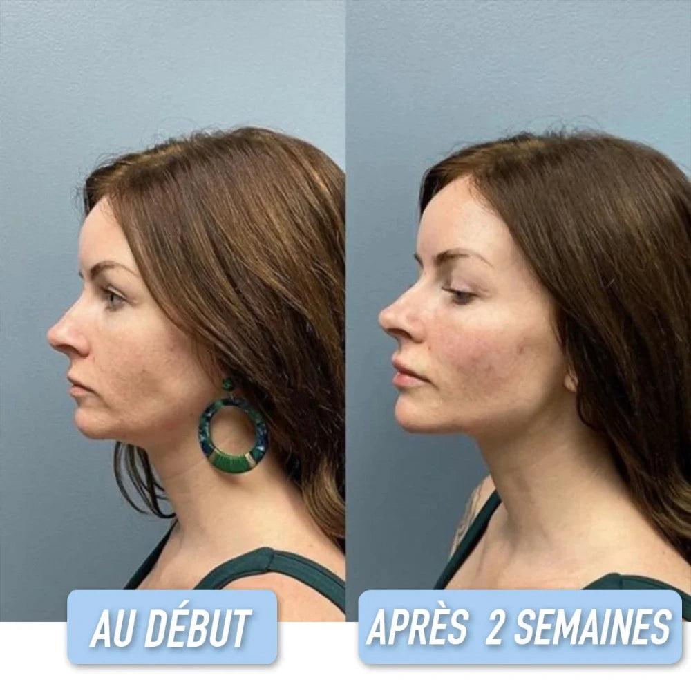 avant après masque double menton