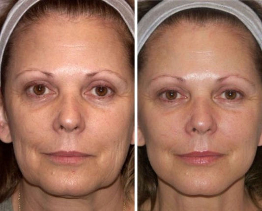 lifting visage sans chirurgie 